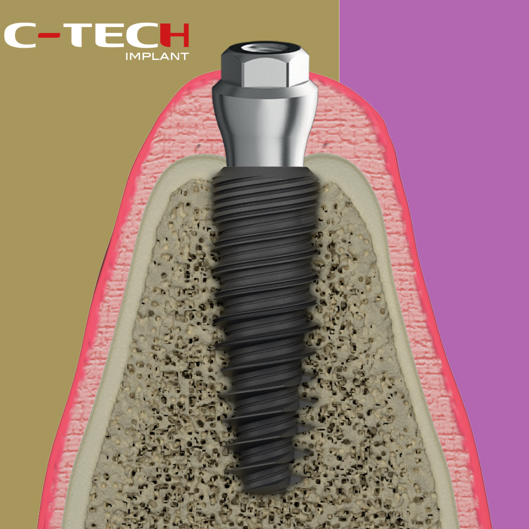 OMNI Abutment CP/EL - Bild 3